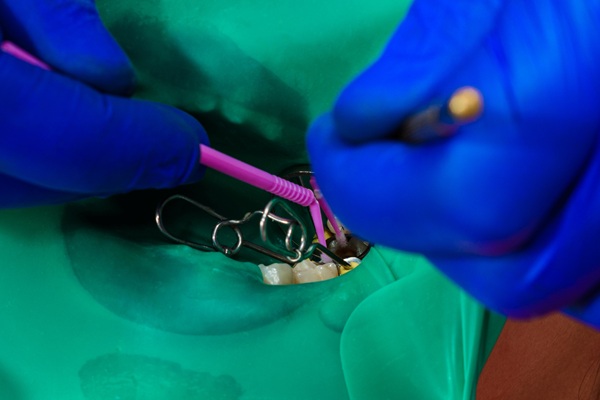 Pediatric Dental Procedure &#    ; Pulpotomy And Baby Teeth